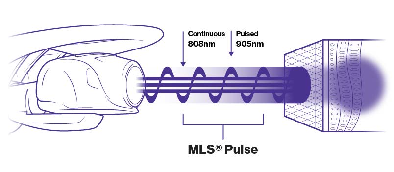 MLS Pulse diagram combining continuous 808 nm light and pulsed 905 nm light